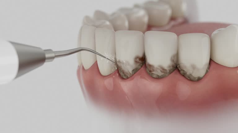 Trusted Teeth Whitening service in Bellevue, OH - Dentist Open Now